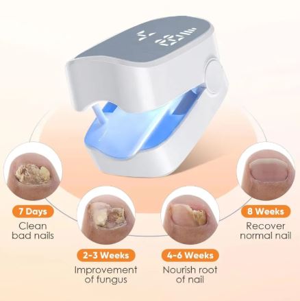Advanced Nail Fungus Laser Treatment Device