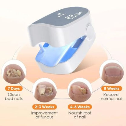 Advanced Nail Fungus Laser Treatment Device